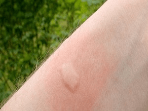 Как отличить укус комара от аллергии