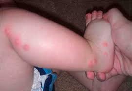 Как выглядит укус клопа на теле ребенка?